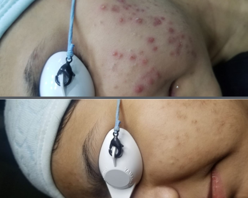 Acne Scar Treatment 1
