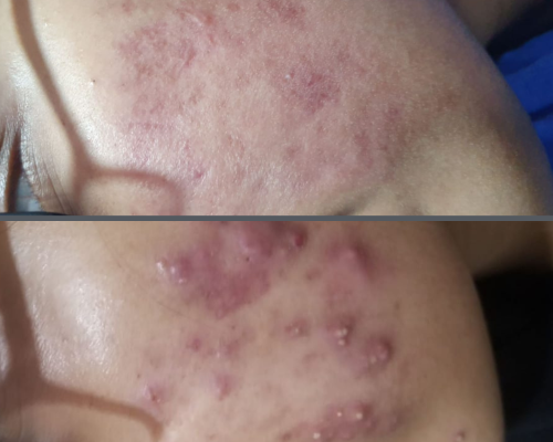 Acne Scar Treatment 2
