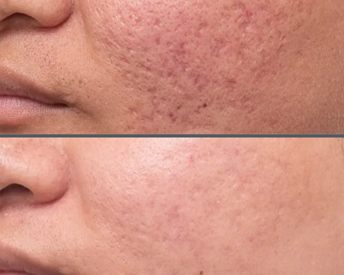 Acne Scar Treatment 4