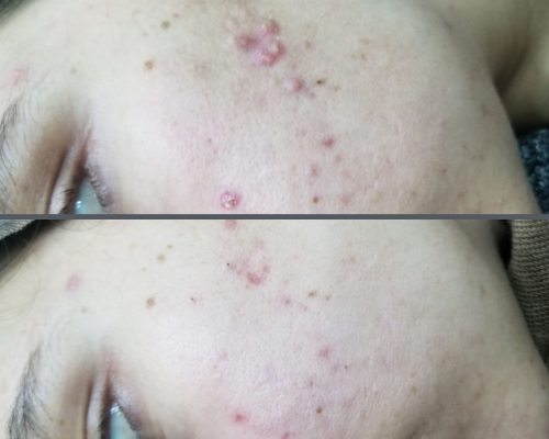Acne scars 3