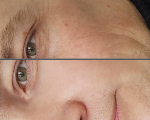 Anti Aging Treatment 1