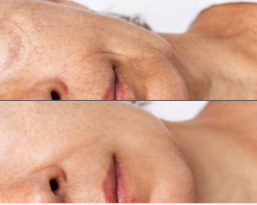 Anti Aging Treatment 2