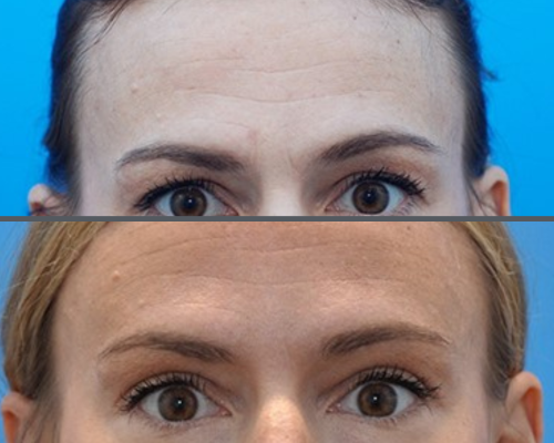 Face and brow lift 1