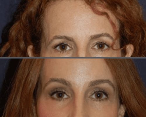 Face and brow lift 2