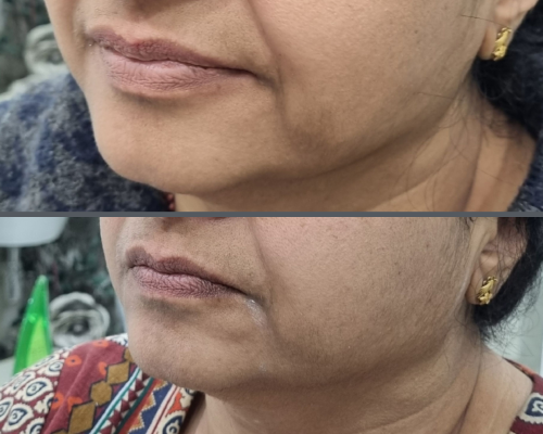 Face and brow lift 3