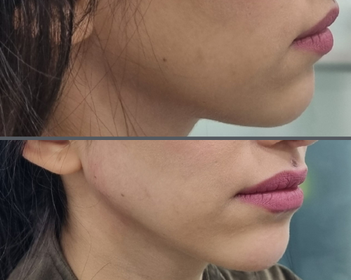 Face and brow lift 4