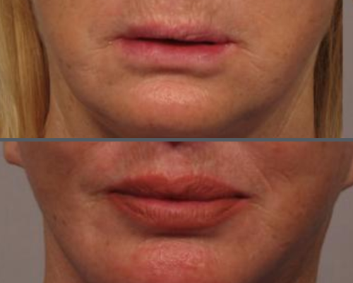 Fat Injections 1 (1)