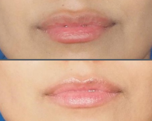 Lip Augmentation 1