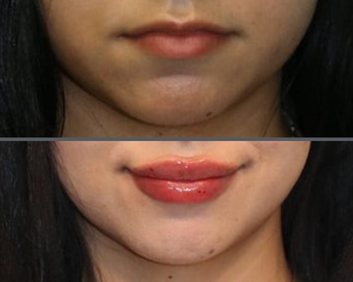 Lip Augmentation 2