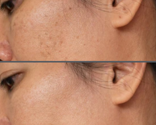 Melasma And Pigmentation 2
