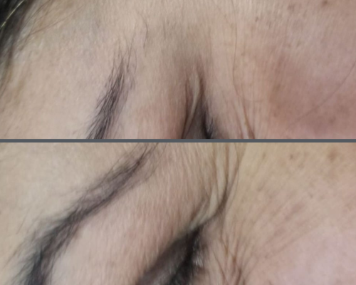 Melasma And Pigmentation 3