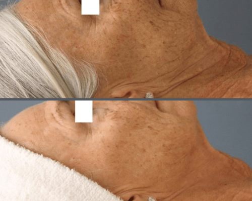RF microneedling 3