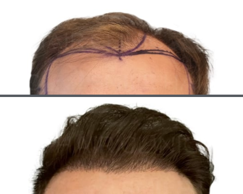hair transplant 4