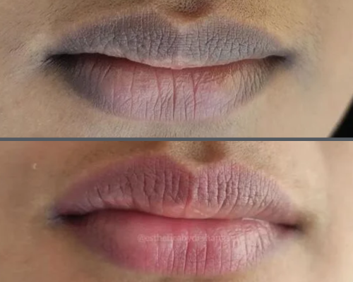 lip pigmentaion 3